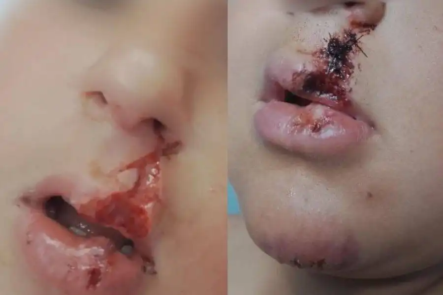 8-year-old boy seriously injured after being attacked by dog in Playa Blanca