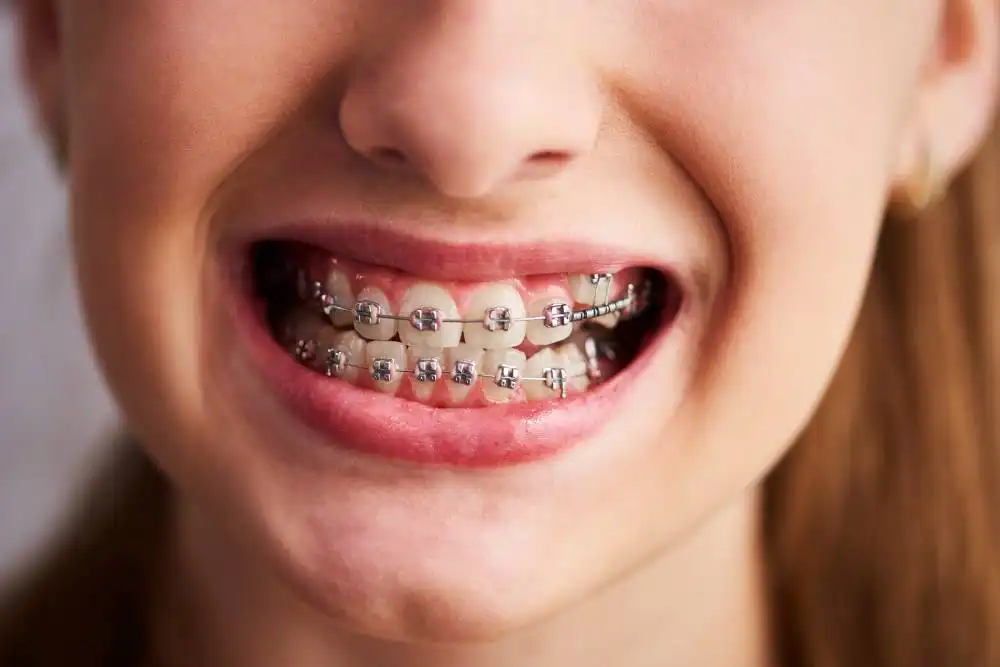 Metal Braces: How they work, benefits, and what to expect