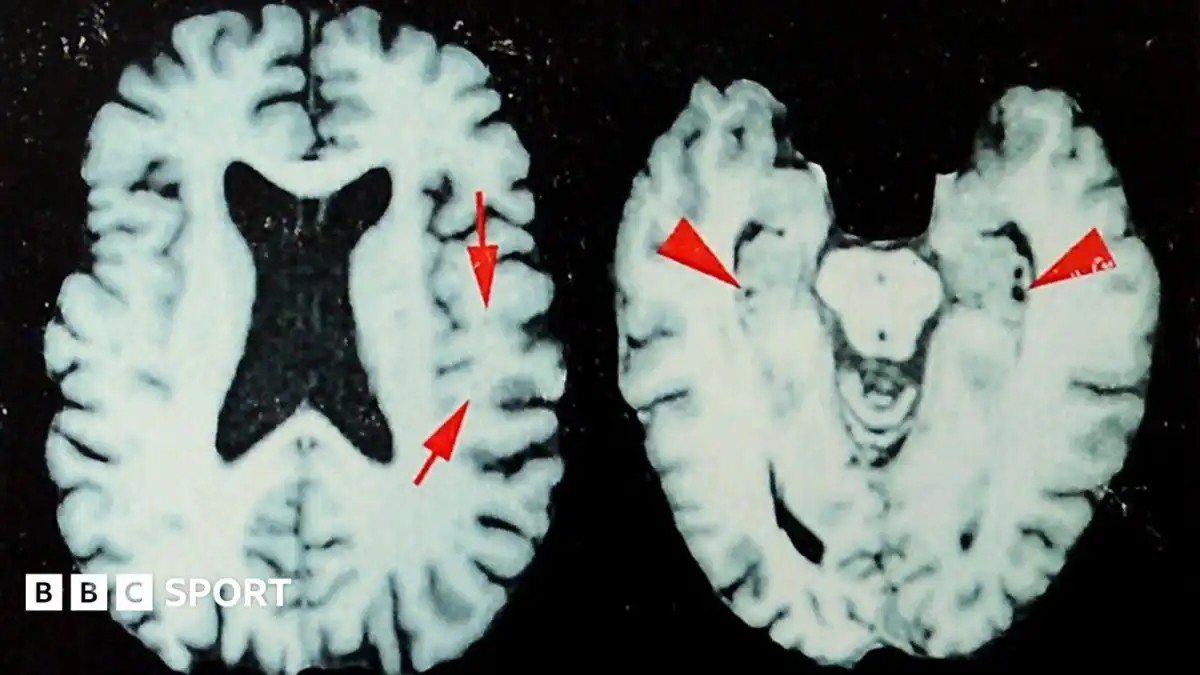 NFL: At least one in four dead players had brain disease, says study
