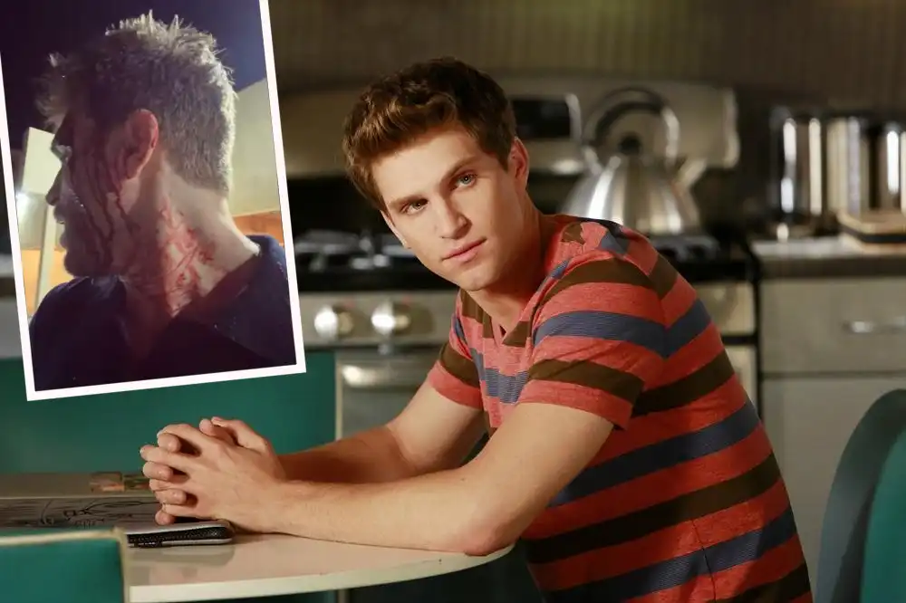 Pretty Little Liars stjarna alblóðug eftir vopnað rán: „Þeir tóku úrið mitt - Fjandinn hafi það“
