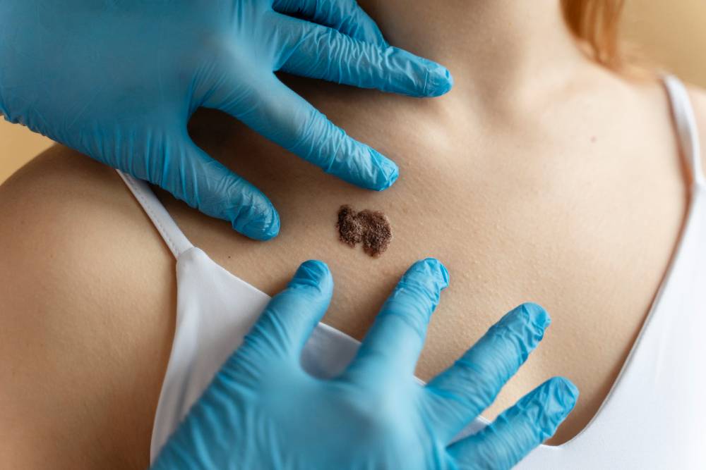 Skin cancer cases surge in the Canary Islands