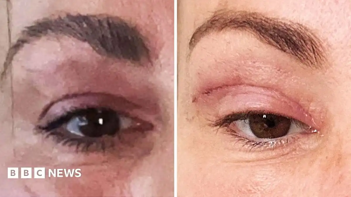 Watch: 'My eyelids became infected - I was scared to sleep'